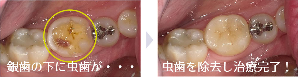 審美歯科症例